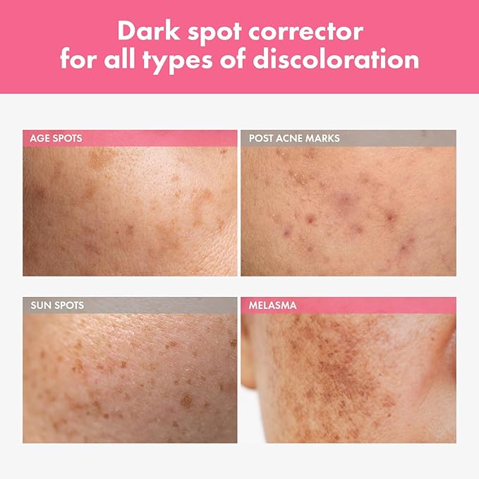 Arbutin 7% Intensive Spot Cream with 70,000ppm Arbutin, 3% Tranexamic Acid, 1% Niacinamide, Glutathione, Dark Spots, freckle, Blemishes, Anti-pigmentation, Korean Skin Care, 20ml, 0.67 fl.oz-GlimoraGlow