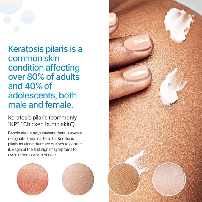 KP Essentials - Keratosis Pilaris Exfoliating Cream - Clear Red Bumps on Thighs and Arms For Confident Clear Skin - 4oz (1 Bottle)-GlimoraGlow