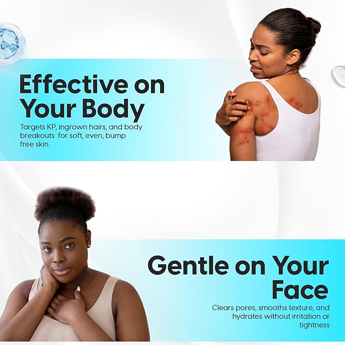 5% Lactic Acid + 2% Salicylic Acid Cleanser –Non-Stripping AHA/BHA Exfoliating Face & Body Wash With Ceramides. Minimizes Pores, Keratosis Pilaris, Acne, Ingrown Hairs & Psoriasis-200ml.-GlimoraGlow