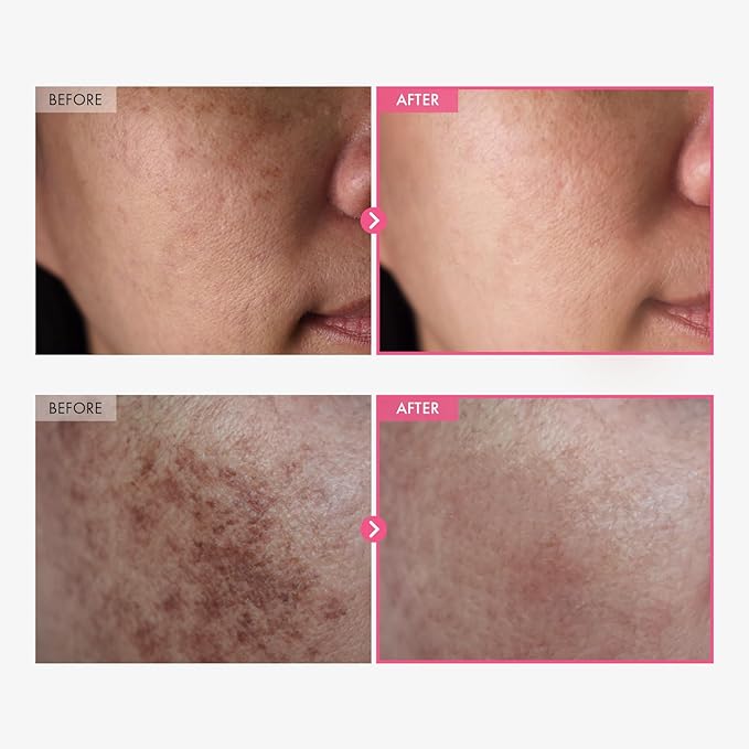 Arbutin 7% + Tranexamic Acid 4% Cream, 70,000ppm Arbutin, 40,000ppm TXA, Niacinamide, Glutathione, Dark Spots, Freckle, Blemishes, Pigmentation, Korean Skin Care, 50ml, 1.69 fl.oz.-GlimoraGlow