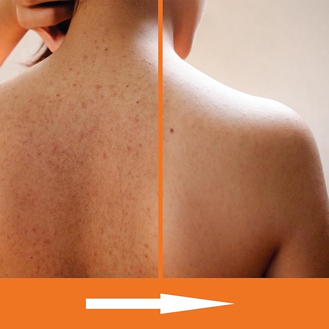 Salicylic Acid Body Wash - Skin Non-drying, Gentle Exfoliates Rough and Bumpy Skin, Body Acne Wash, BHA & AHA - Unscented Exfoliating Body Wash, Made in USA - (16 fl oz x 2)-GlimoraGlow