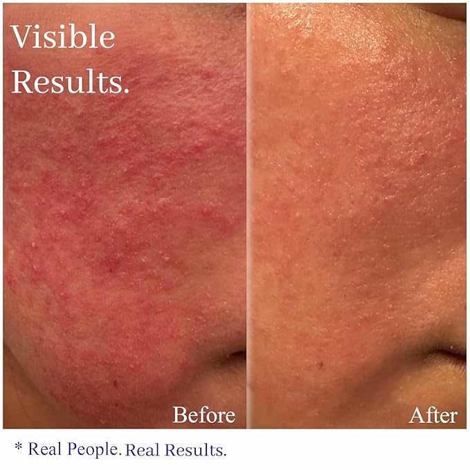 Hey Honey Skincare Relax, Instant Rosacea Treatment & Face Redness Relief - Dermatologically Tested Calming Moisturizer for Sensitive Skin Oil- Free with Honey & Propolis Anti-Aging Benefits | 2.2 Oz-GlimoraGlow