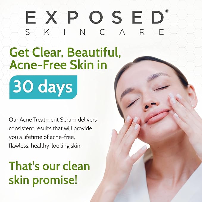 Exposed Skin Care Acne Treatment Serum Step 3 – Quickly Reduces Pimple Size and Redness - 12 Hour Spot Treatment - 3.5% Benzoyl Peroxide, Natural Green Tea & Tea Tree Oil-GlimoraGlow