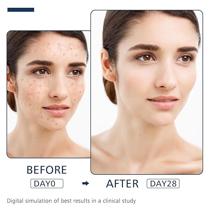 Dark Spot Remover for Face and Body - Dark Spot Advanced Corrector Serum for Melasma, Age Spots, Freckles & Sun Spots, with 360° Roller for All Skin Types-GlimoraGlow