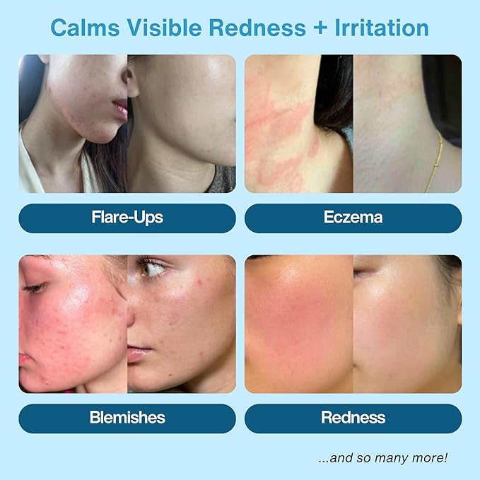 Hypochlorous Acid Spray – HOCl Face & Body Mist for Acne, Eczema & Irritation – Multi-Purpose Skin Repair – Eyelid Cleanser, Post-Workout/Procedure, Scalp & Sensitive Skin (2 oz+6.8 oz)-GlimoraGlow