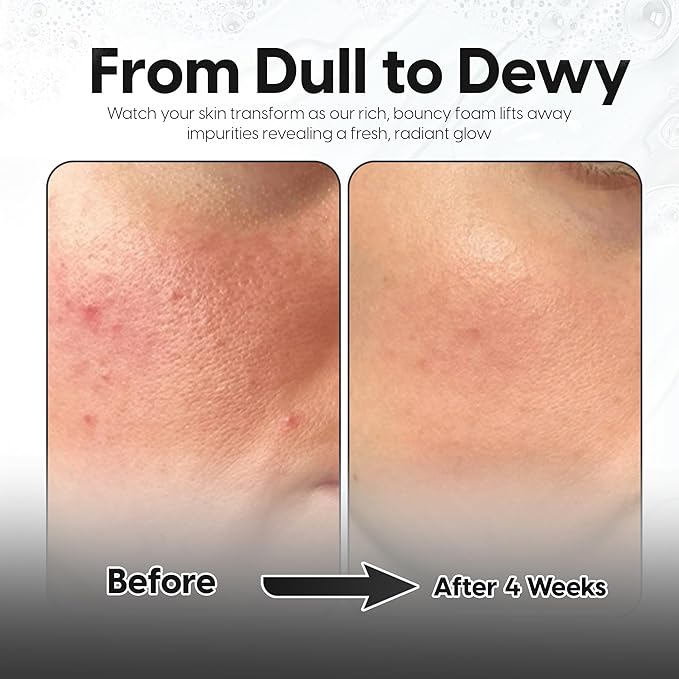 5% Lactic Acid + 2% Salicylic Acid Cleanser –Non-Stripping AHA/BHA Exfoliating Face & Body Wash With Ceramides. Minimizes Pores, Keratosis Pilaris, Acne, Ingrown Hairs & Psoriasis-200ml.-GlimoraGlow