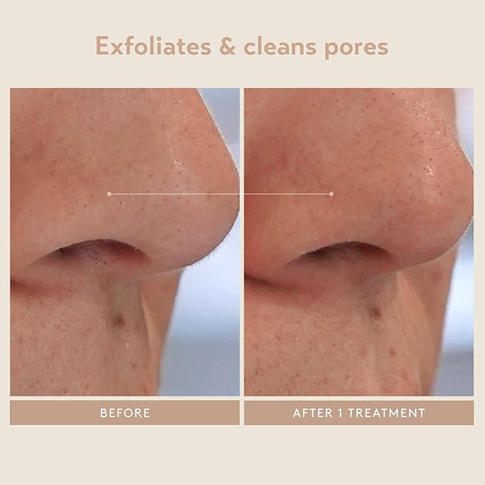 SHANI DARDEN SKIN CARE Triple Acid Peel, 2-Step Exfoliating Face Peel with Mandelic, Lactic & Glycolic Acids, Kaolin Clay Neutralizing Mask & Brush, Helps Improve Dark Spots & Skin Texture, 1.69 fl oz-GlimoraGlow