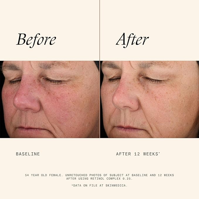 SkinMedica Retinol 0.25 Complex - Retinol Serum for Face, Age-Defying Advanced Retinol Cream That Renews Skin and Diminishes the Appearance of Fine Lines and Wrinkles, 1 Fl Oz-GlimoraGlow