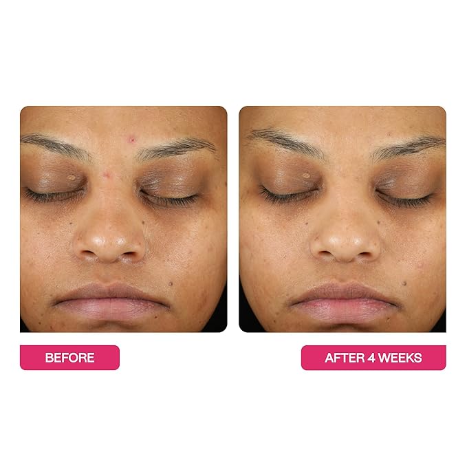 BeautyStat Triple Action One-Step Daily Exfoliating Peel Pad for Uneven Tone, Texture, Fine Lines, Enlarged Pores - Made in the USA - Gentle Exfoliator Pad with AHAs, BHAs, Glucosamine to Brighten-GlimoraGlow