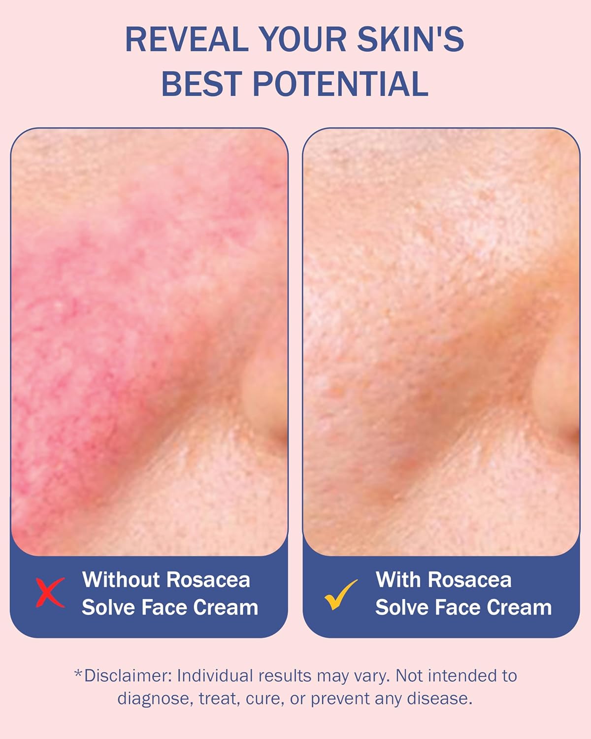 Rosacea Treatment for Face Skincare Cream for Women & Men (Pack of 2) - Gentle Moisturizer Redness Reducing Skin Care - with Aloe Vera & Hyaluronic Acid - Day-Night, Made in USA by e70 (2.25 fl. oz.)-GlimoraGlow