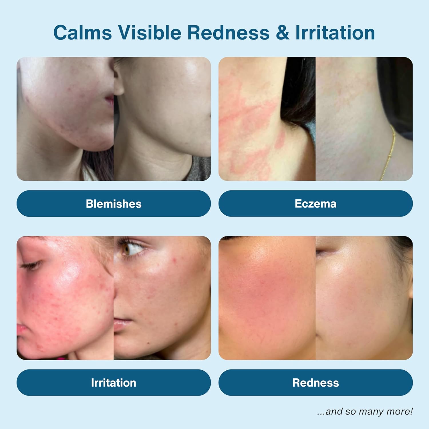 Hypochlorous Acid Spray - HOCL - Hypoallergenic Skin Toner Cleanse and Soothe Sensitive Face - Acne - Eczema - Bacne - Eyelid - Pre Post Workout (Mini Bundle Pack - 2fl + 2 fl)-GlimoraGlow