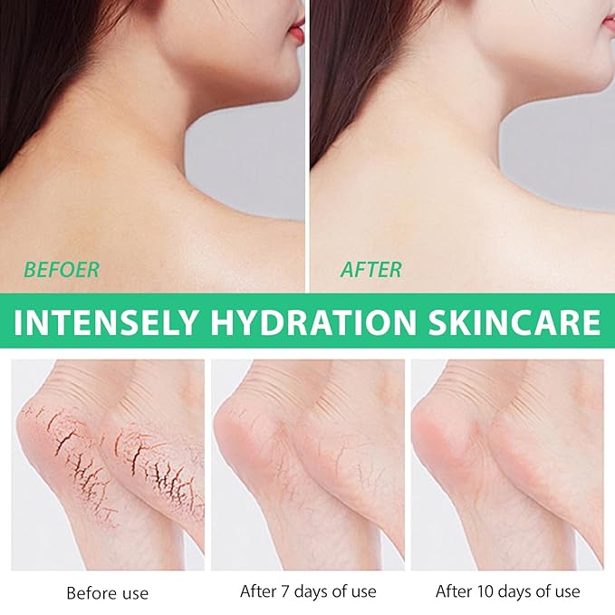 J&H Jasmine&Hyacinth 40% Urea Cream with 2% Salicylic Acid, Aloe, Feet/Heel Cream Moisturizer for Dry Cracked Heel, Knees, Elbows, Hands, Callus Remover, Intensive Hydrating Treatment-5.3 OZ/150 G-GlimoraGlow