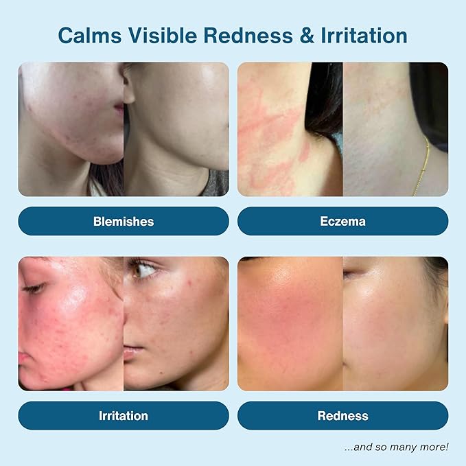 Hypochlorous Acid Spray – Eyelid Cleanser, HOCl Face & Skin Mist for Acne, Eczema & Irritation – Multi-Purpose Skin Repair – Post-Workout, Scalp & Sensitive Skin, Travel Size - 2 oz-GlimoraGlow