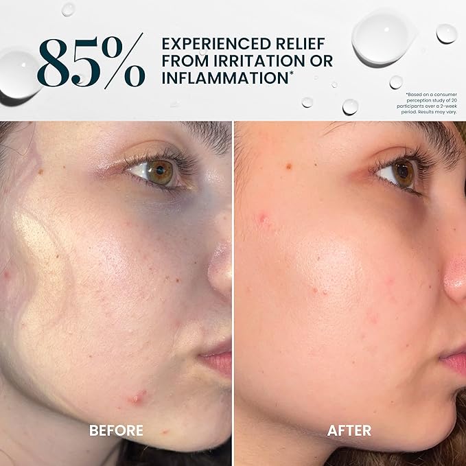 FlutterHabit Hypochlorous Acid Spray, Face Mist for Acne Prone Skin, HOCl Formula to Soothe Irritation, Refresh Complexion, Repair Damage, Balance Oil, Calm Redness, Restore Clarity (125mL)-GlimoraGlow