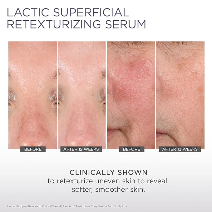 Glytone Micro-Peel Lactic Superficial Retexturizing Serum | Anti-Aging AHA Exfoliating Serum for Face with 10% Lactic Acid | Hydrates, Brightens & Reduces Wrinkles | Paraben-Free - 1 Fl oz-GlimoraGlow