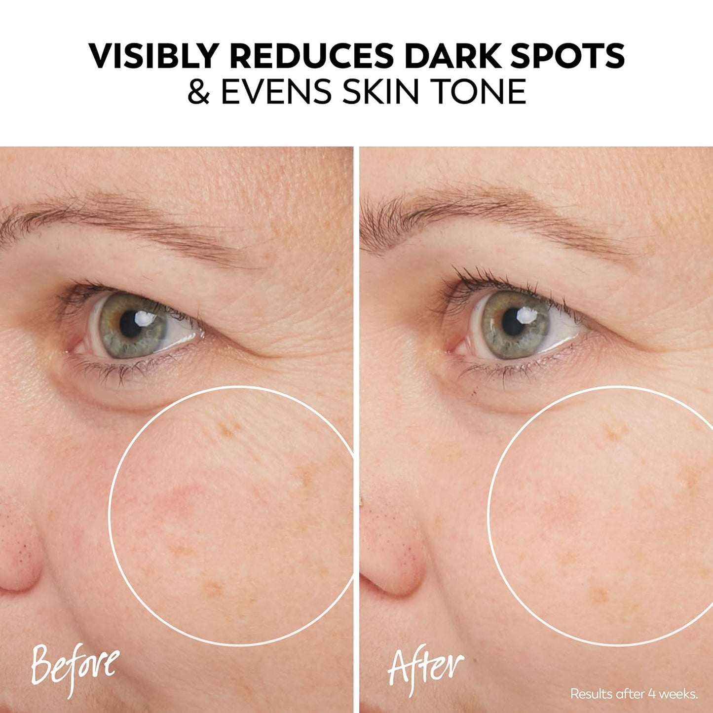 Olay Pro-X Dermatological Even Skin Tone Spot Fading Treatment Serum, 1.3 oz-GlimoraGlow