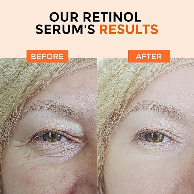 Face Serum Set – Retinol Serum & Hyaluronic Acid for Face – Anti Aging Skin Care Set for Women – Firm, Wrinkle Smoothing-GlimoraGlow