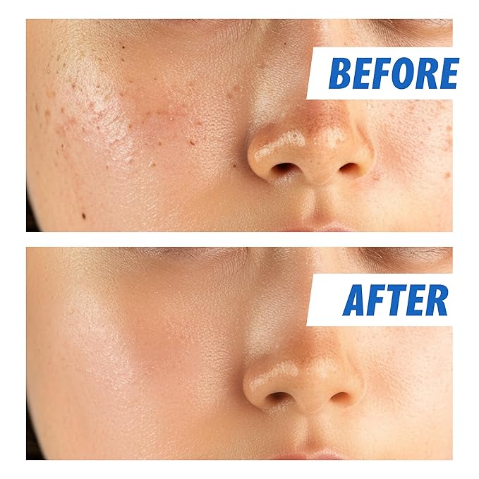 Nightingale Ecto-hyaluronic Ampoule with Hyaluronic Acid, Ectoin, Hydrating Face Serum for Dry Skin, Non-greasy formula, Hypoallergenic, Fragrance & Alcohol Free, Allergen Free, Cruelty Free, Vegan-GlimoraGlow