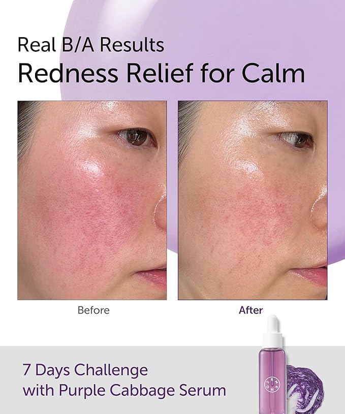 SERUMKIND Purple Cabbage Serum - Calming and Skin Recovery- Korean Face Skincare – Beta Glucan 100,000ppm – Soothing & Redness Relief - Vegan, Cruelty-Free – 1.01 fl.oz.-GlimoraGlow