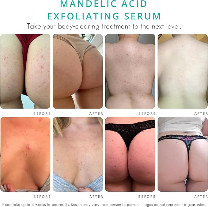 Body Clearing Serum [1 Fl Oz] Level 2 Acne Serum - Advanced Formula for Body Acne, Folliculitis, Back, Butt, Chest, Thighs, Shoulders - Mandelic Acid-GlimoraGlow