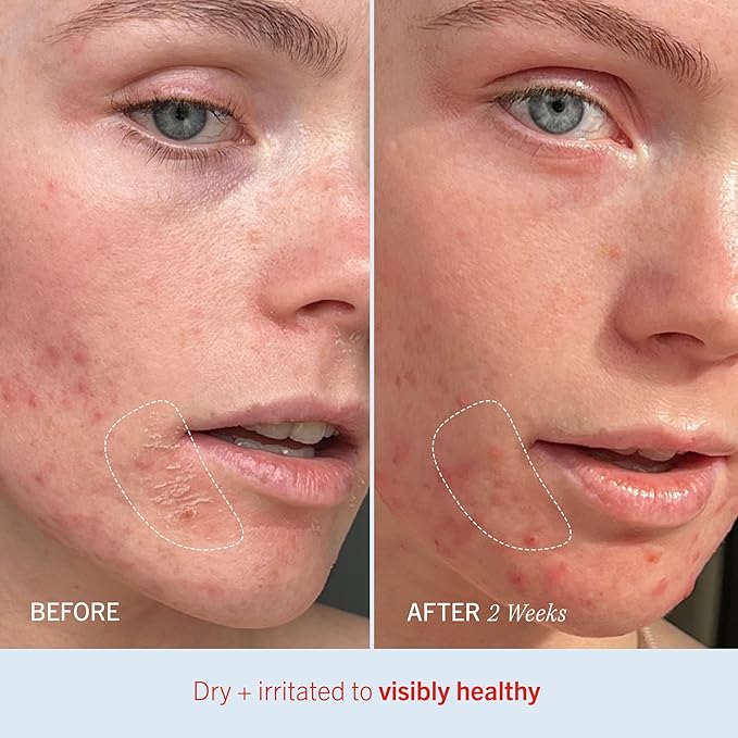 First Aid Beauty - Ultra Repair Cream, Intense Hydration Whipped Colloidal Oatmeal, Clinically Proven to Strengthen Skin Barrier in 7 Days & Helps Relieve Eczema, Luxury Face & Body Moisturizer, 8 oz-GlimoraGlow