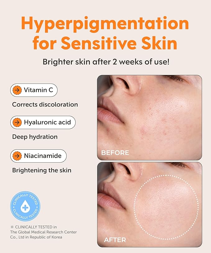 SERUMKIND Vitamin C Serum for Korean Face Skincare – Brightening for Dark Spots, Pore Refining, Discoloration Correcting – With Niacinamide – Reduces Fine Lines and Wrinkles-GlimoraGlow