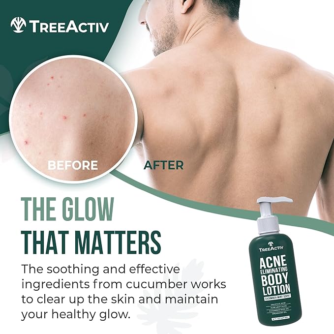 TreeActiv Acne Eliminating Body Lotion 8 fl oz | Clears Body, Back, Butt and Shoulder Acne | Anti-Acne Moisturizer | Prevents Future Breakouts | Cucumber Mint Scent-GlimoraGlow