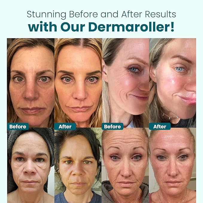 Gin Amber Beauty Derma Roller with Replaceable Head Design – 192 Real individual needles, Micro Needling Roller for Face, Beard, and Scalp Care, 0.25mm Face Roller-GlimoraGlow