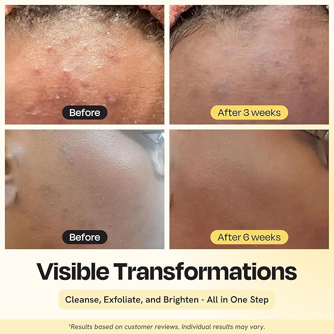 Gleamin Vitamin C Face Wash & Facial Cleanser - Cream to Foam 2% Salicylic Acid Cleanser with Paw Paw & Turmeric - Gentle Exfoliating Facewash for Women & Men, Oily & Combination Skin, 3.4 fl oz-GlimoraGlow