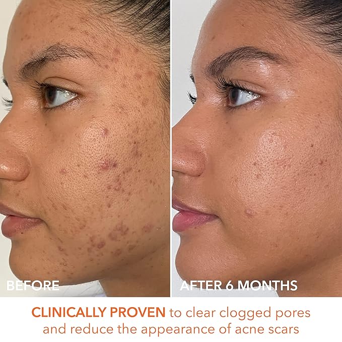 Dr. Dennis Gross Alpha Beta Extra Strength Daily Peel: for Oily Skin, Uneven Tone or Texture, Wrinkles or Enlarged Pores (30 Treatments)-GlimoraGlow