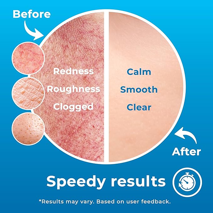 Hypochlorous Acid Spray (8oz, 2 packs), HOCL Facial Cleanser Acne Spray for Face, Body, Eczema, Pimples, Breakouts & Overall Skin Recovery (Reduces Redness)-GlimoraGlow