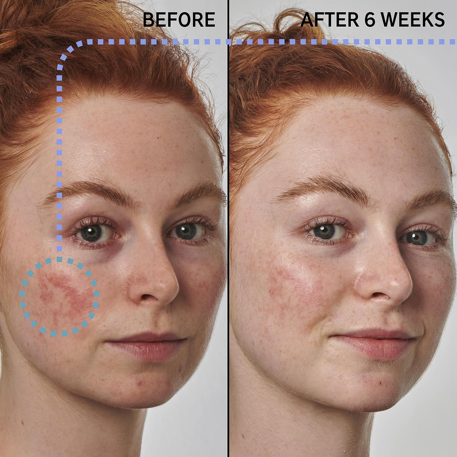 The INKEY List SuperSolutions Azelaic Acid 10% Serum, Fast-Absorbing Formula Helps Reduce Appearance of Redness and Soothes Skin, Leaves No White Cast, 1.01 fl oz-GlimoraGlow