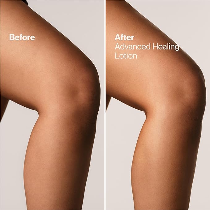 Suave+ Advanced Healing Hand & Body Lotion for Women With Ceramides for Very Dry Skin, Hydrating, Non-Greasy, Allergen-Free Moisturizing Cream, Lightly Scented, 18 FL OZ, 6 Pack-GlimoraGlow