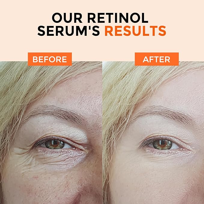 Retinol Serum for Face 2.5%, B5 Resurfacing Retinol Serum with Vitamin C, Vitamin E, Hyaluronic Acid, Niacinamide, Peptide for Anti-Aging, Wrinkle Smoothing, Dark Spot Corrector, Brighten Dullness-GlimoraGlow