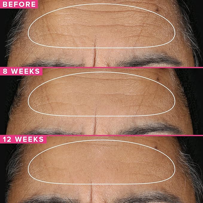 Farmacy Retinol Serum for Face - 1% Vitamin A Anti Aging - Resurfacing Wrinkle Formulated with Encapsulated Retinol + Ceramide NP to Prevent Moisture Loss + Replenish Skin Barrier (30ml)-GlimoraGlow